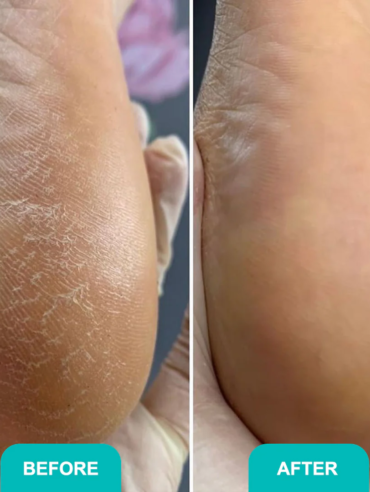 Foam_express_softener_for_pedicure-2_78d8b38c-c720-4ee8-b2f8-3ffea72565ba