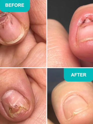 Oil_for_damaged_nail_plate