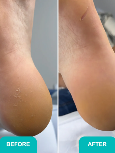 alluse_and_corns_softening_gel_Soft_Blade-1