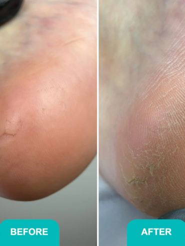 alluse_and_corns_softening_gel_Soft_Blade-2